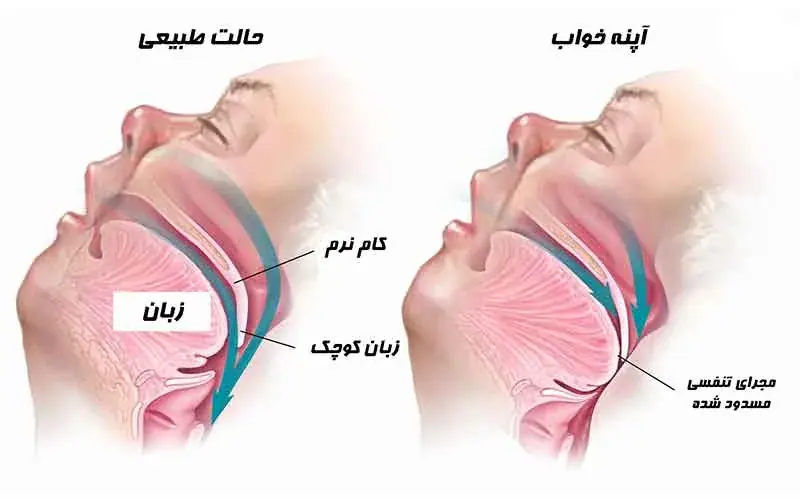 آپنه خاب